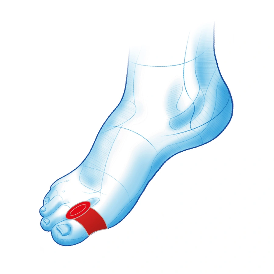 separator-klin-na-hallux-oddzielajacy-palce-mazbit-haluks-duo-2.webp