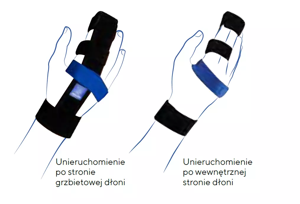 orteza-palca-reki-po-zlamaniu-kosci-srodrecza-ligaflex-finger-thuasne-3.webp