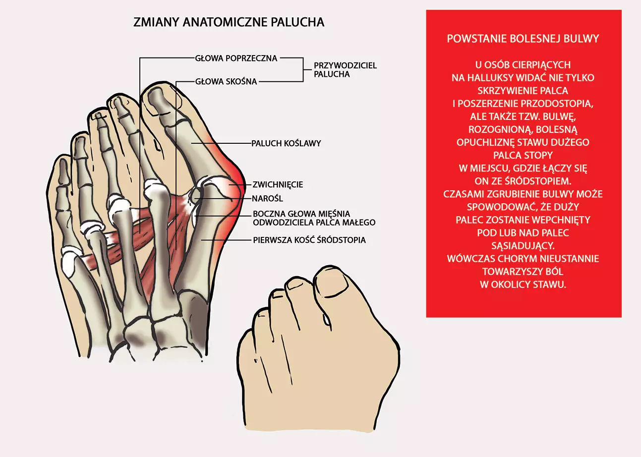 orteza-aparat-na-haluksa-palca-u-stopy-am-op-03-reh4mat-sposob-deformacji-haluksa.webp