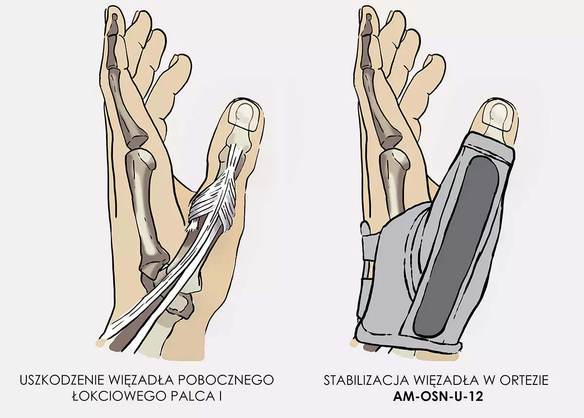 orteza-na-kciuk-narciarza-z-usztywnieniem-am-osn-u-12-reh4mat-12.webp