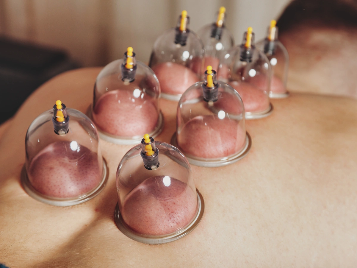 Bańki bezogniowe do stawiania na plecy u dzieci